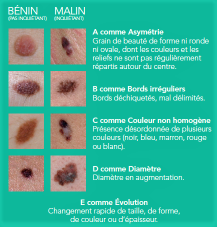 Comment se forment les grains de beauté? - Endroit Curieux